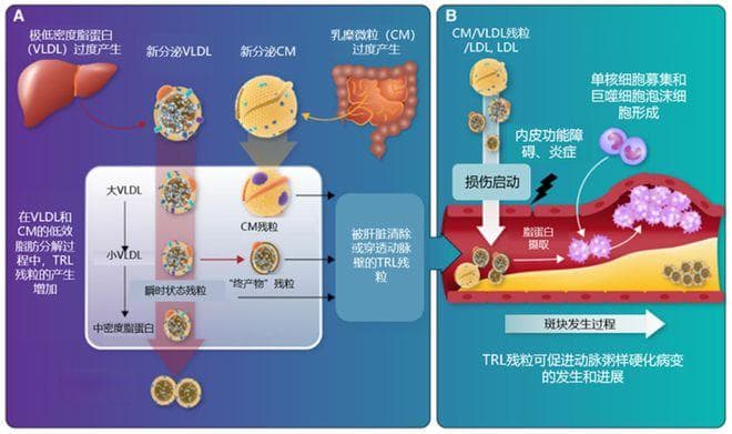 中国血脂管理指南更新：甘油三酯管理要点解读