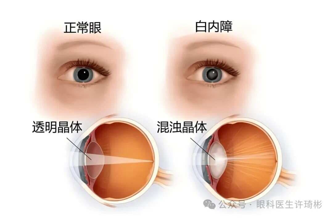 眼科专家解读白内障：症状、成因与治疗全攻略