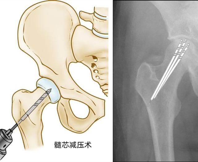 股骨头坏死早期，应该怎么办，听听医生怎么说