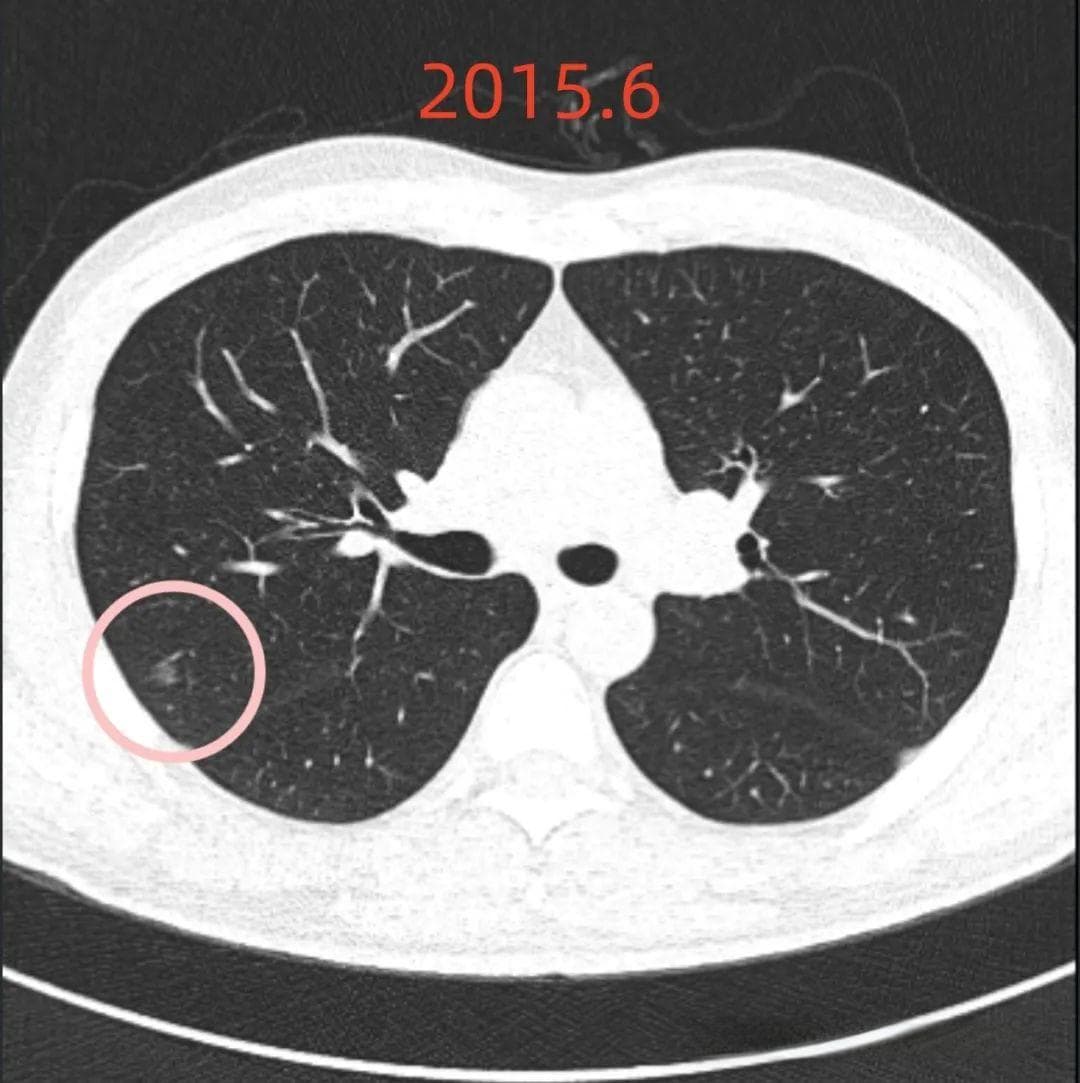 9年随访揭示肺磨玻璃结节风险评估：后来者居上，需谨慎评估