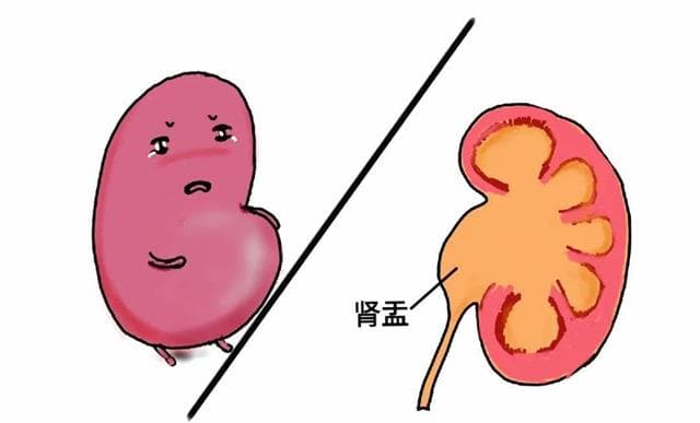 胎儿先天性肾积水全解析：从发现到治疗的关键知识