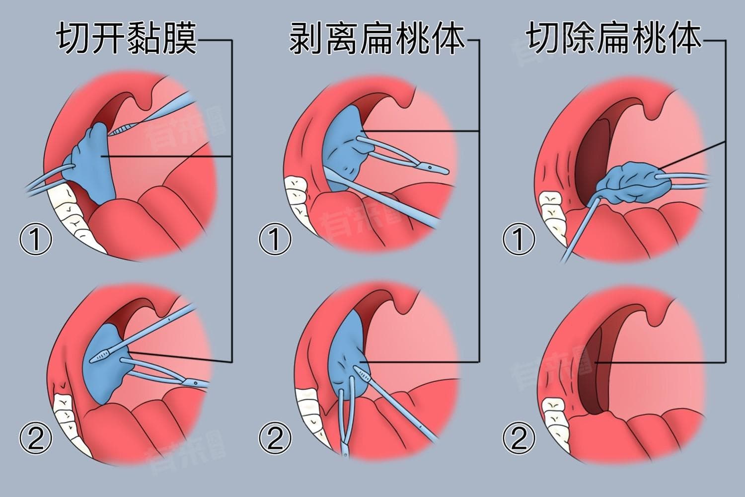 扁桃体手术要多少钱？这些因素会影响最终费用