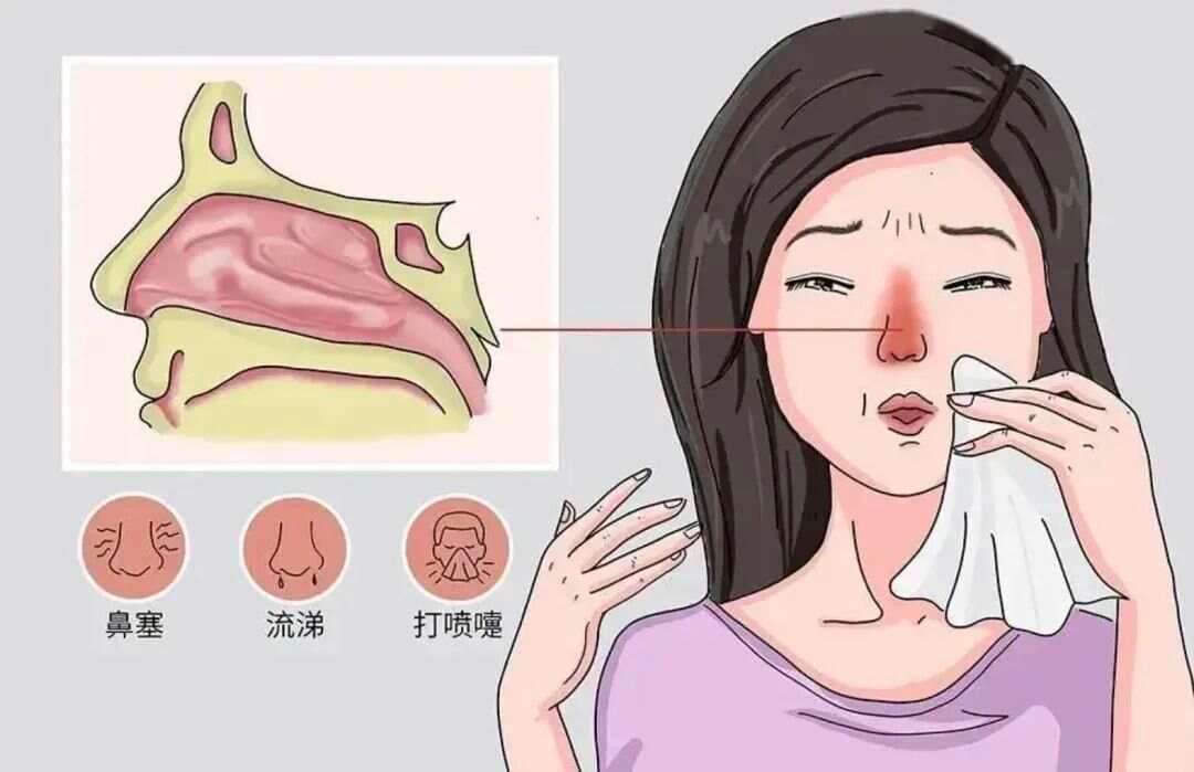 疼痛科治疗过敏性鼻炎：三种创新疗法详解