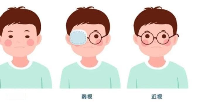 一眼清晰一眼模糊？警惕屈光参差“偷走”你的立体视觉