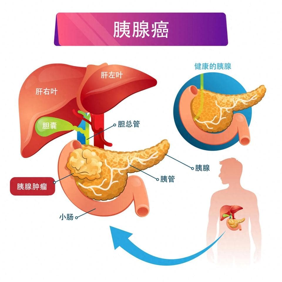 “癌中之王”也可“早防早治”：一毛钱早筛胰腺癌