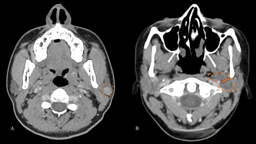 腮腺肿瘤的MRI 和CT表现