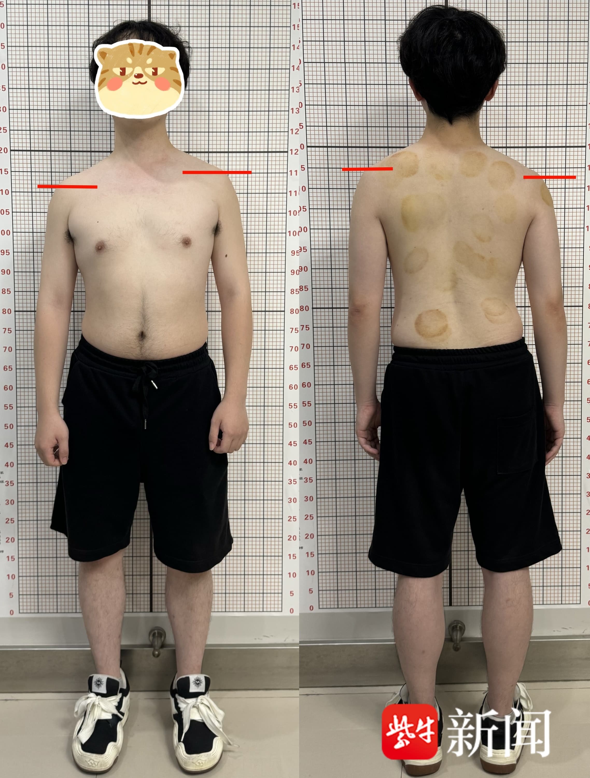 孩子高低肩、肩胛骨不对称？可能是脊柱侧弯了！三个方法可自查