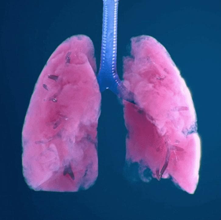 肺结节的真相：化妆真的会导致肺结节吗？