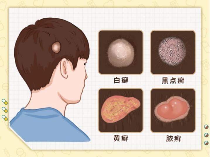 头癣有哪些类型？怎么治疗？