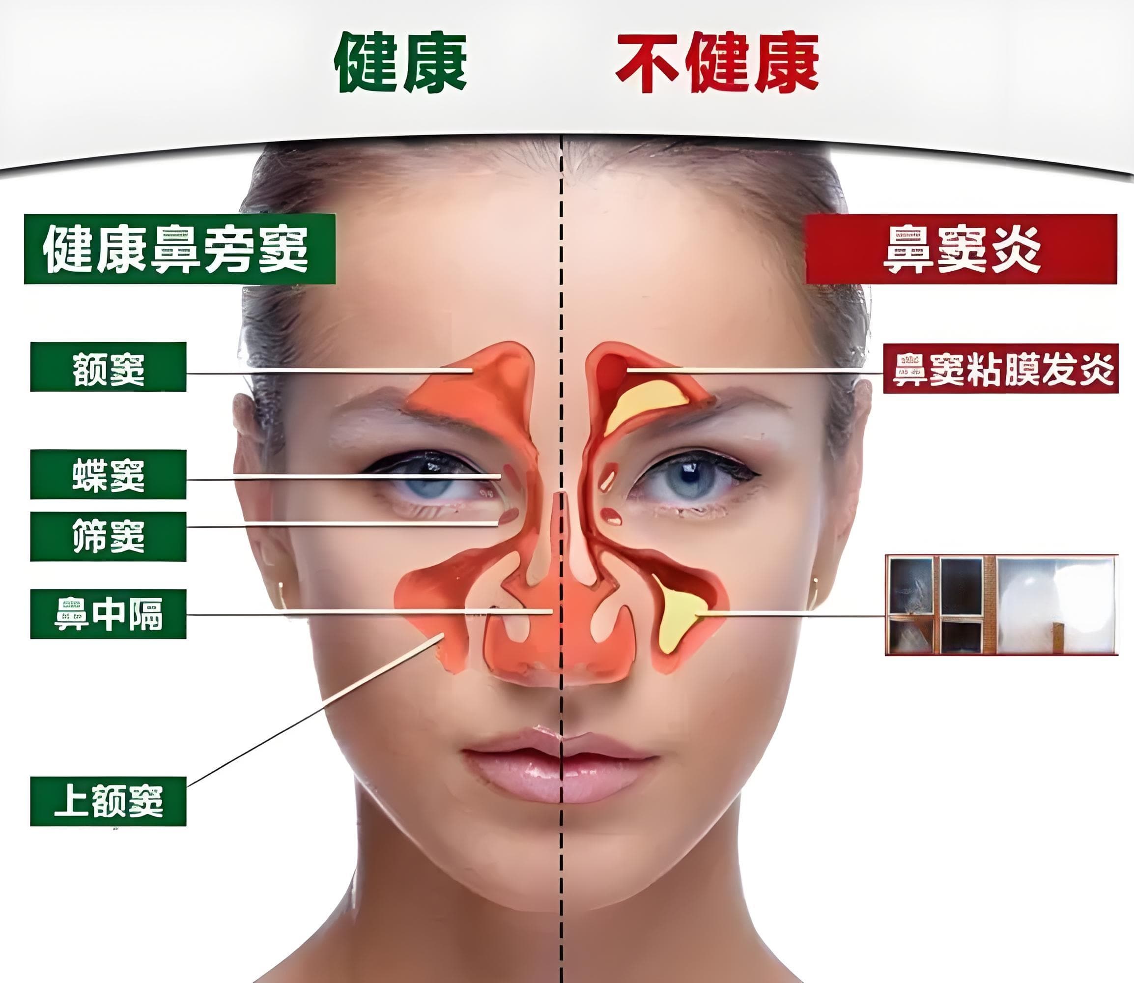 鼻炎真的会引起头痛吗？如何识别并预防