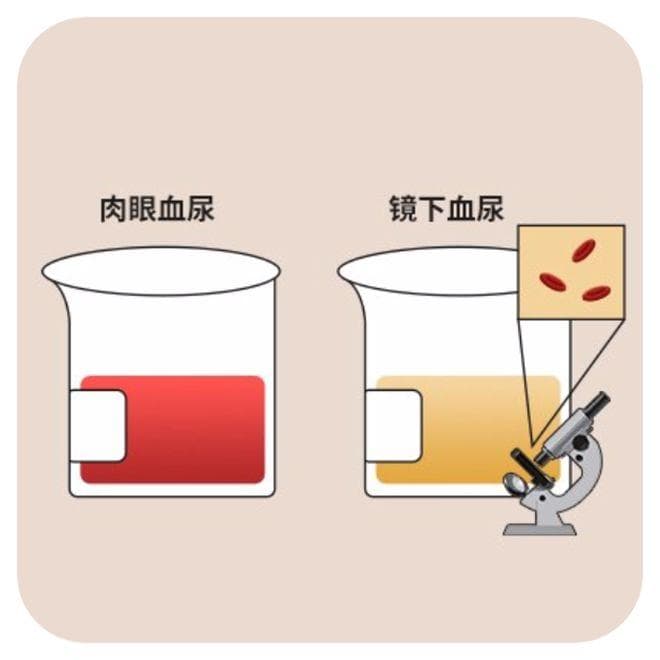 喝水有助于排结石？再三提醒：尿路结石高发，做好3点很重要