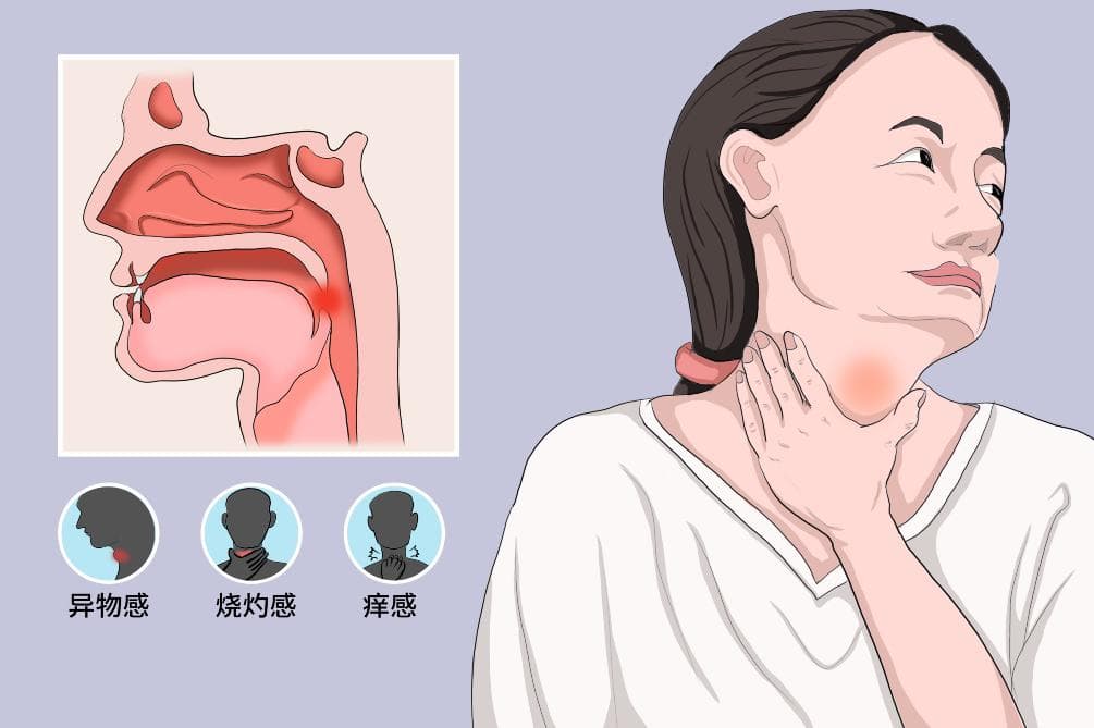 癔球症：症状、诊断与治疗全解析