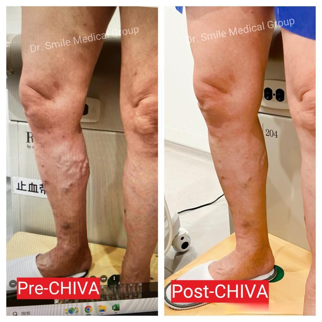 冬季是静脉曲张病情恶化的高峰期，CHIVA技术如何发挥作用？