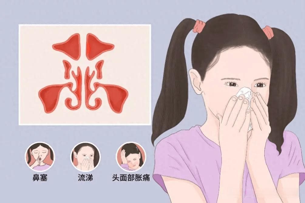 协和医生说｜鼻塞流涕、头面胀痛、嗅觉减退？一文详解慢性鼻窦炎