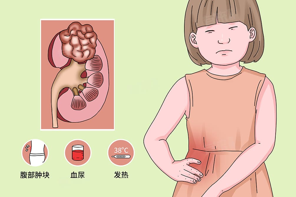 Wilms瘤是什么病，能治愈吗