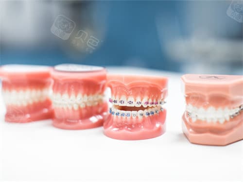 矫正牙齿3万块钱到底贵不贵？多方面解析影响牙齿矫正价格的因素