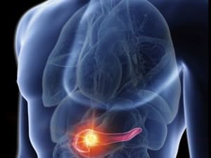 胰腺癌患者临终前15个征兆