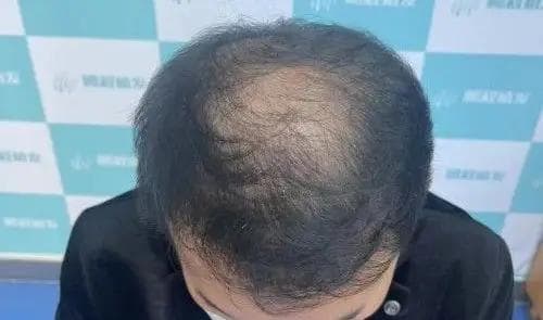 脱发人千万注意！这些药有毒性！万不可和非那雄胺一起吃！