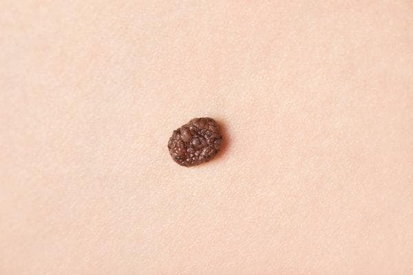 大便里有黑色颗粒？可能是这些原因