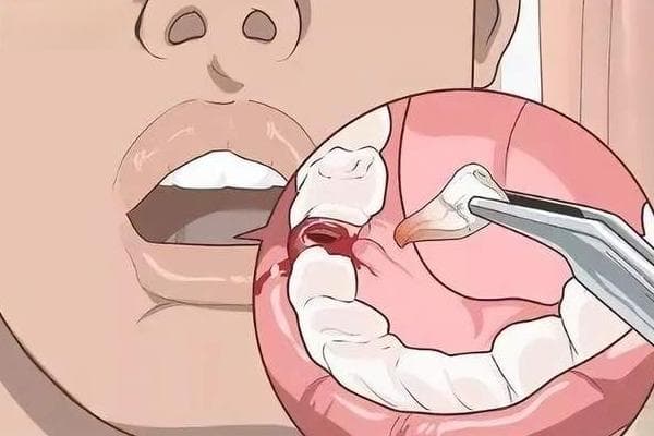 拔牙后多久可以正常吃饭？这有一份拔牙护理指南请收好