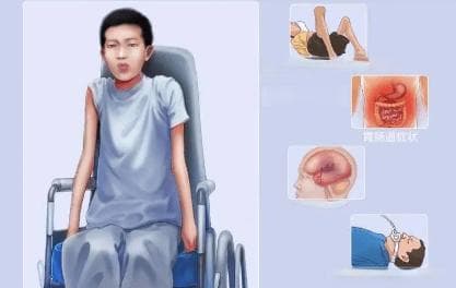 肌营养不良中医辨证施治？