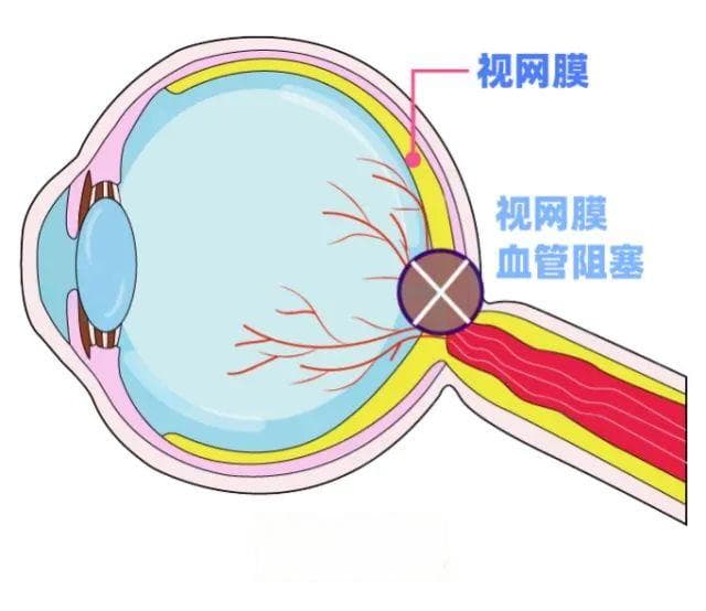 95后一觉醒来“眼中风”，医生提醒……