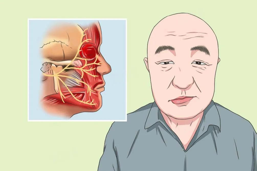 面瘫后遗症能治好吗