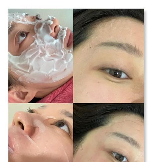 白糖真的能去除痘印吗？有效方法是什么？