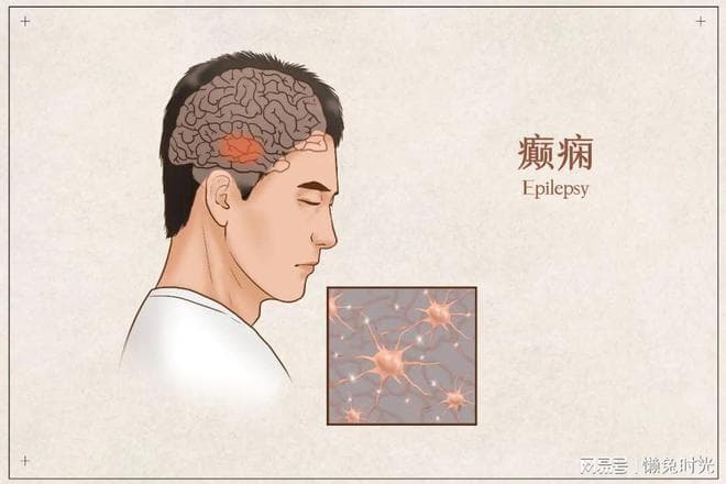 癫痫发作，能不能叫醒他？这些要点你务必要清楚！