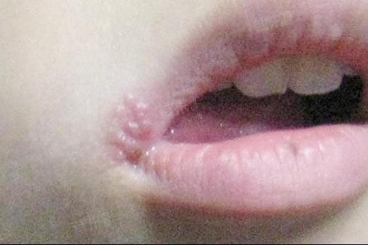 熬夜上火的原因及预防方法
