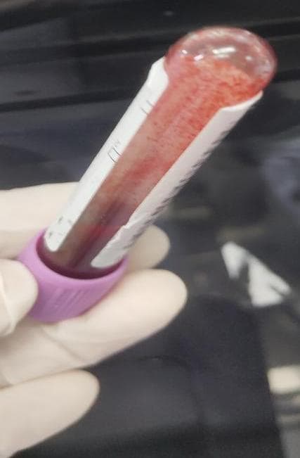 冷凝集致血常规结果异常的识别及处理策略