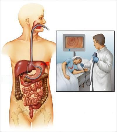 早期发现食管癌的关键——胃镜：你真的需要害怕吗