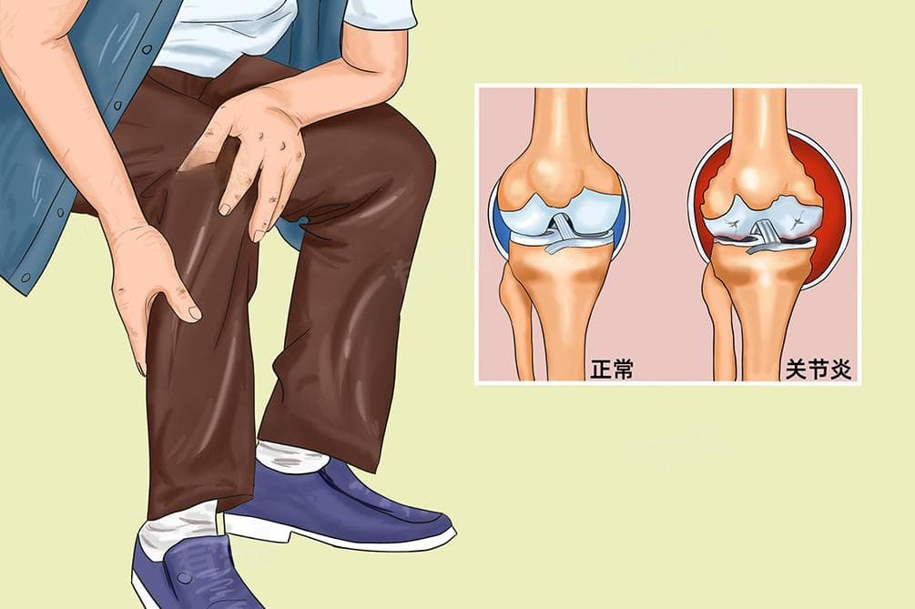 关节炎怎么治疗能彻底除根