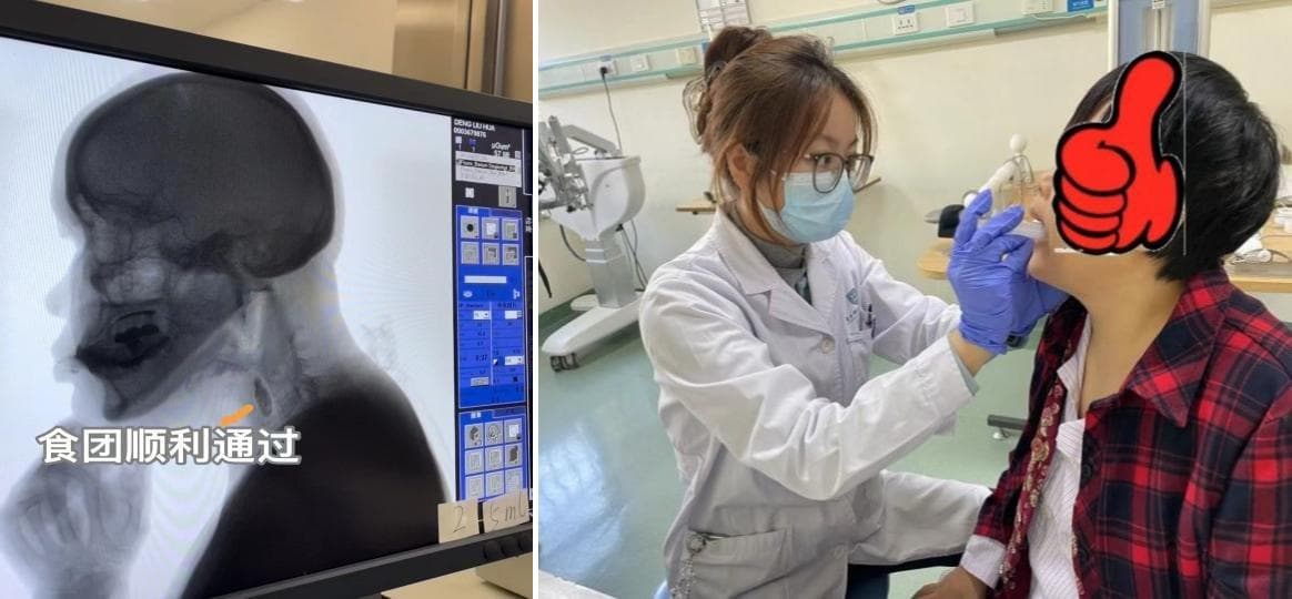 吞咽障碍患者的福音！康复医学科吞咽评估、治疗一体化成效显著
