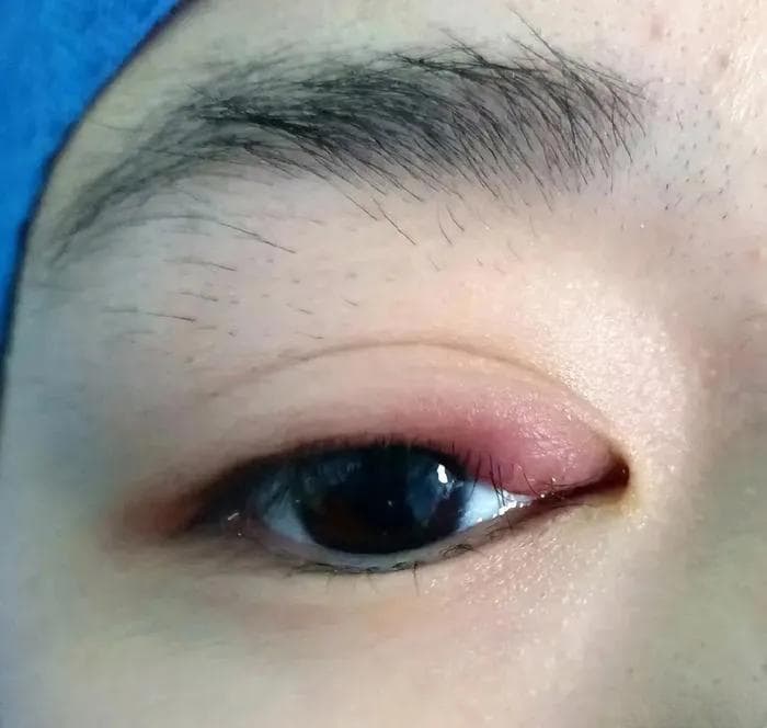麦粒肿？霰粒肿？这个“慢性子”的眼科疾病您认识吗？