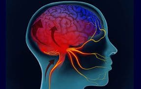 《柳叶刀》特辑：偏头痛的流行病学特征、疾病机制以及疾病管理