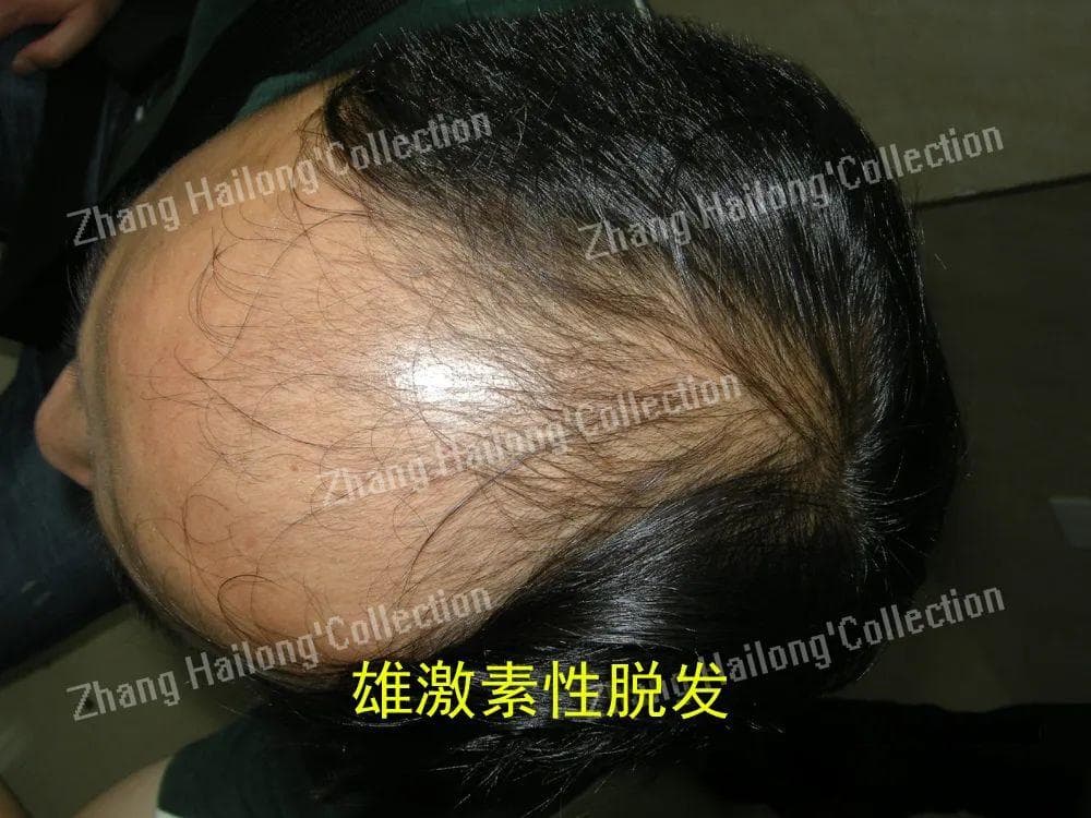 微针治疗脱发性疾病的研究进展