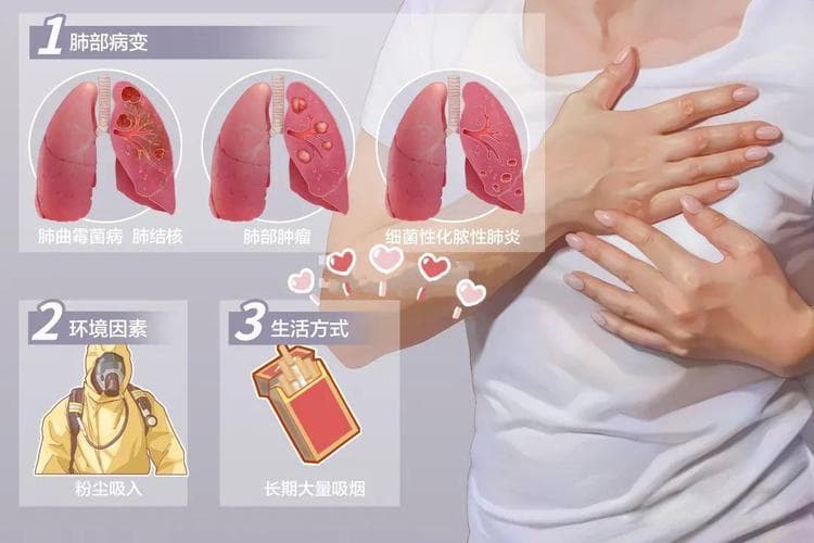 肺磨玻璃阴影小知识之一