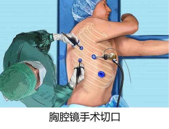“肺腑之谈，胸中有术”——肺癌手术的常见方式及术后并发症