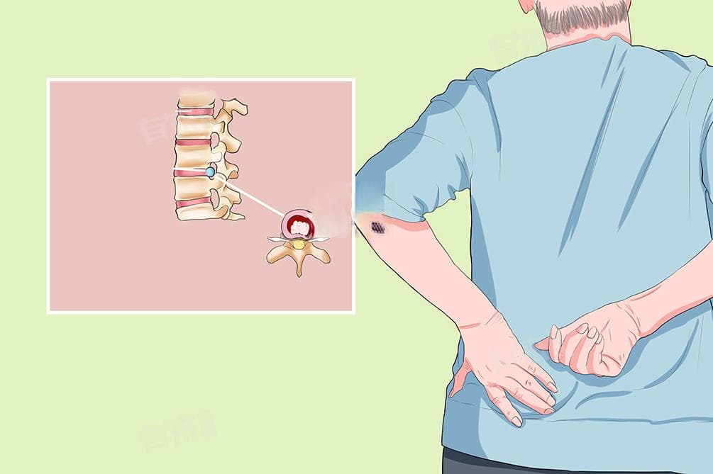 腰椎间盘膨出的定义、原因及治疗方法