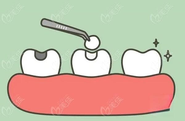 门牙磕掉一小块怎么补?可做树脂补牙或瓷贴面、全瓷牙冠修复