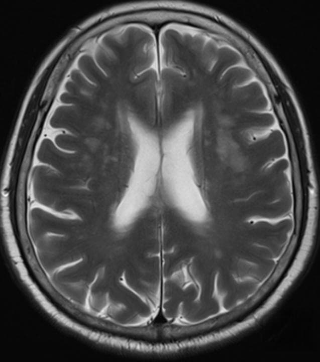 检查报告上的“腔隙性脑梗死”是什么，需要治疗吗？