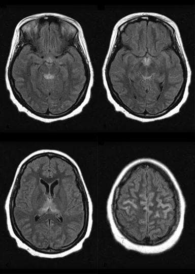 从Wernicke脑病到Korsakoff综合征：病因、症状与诊断