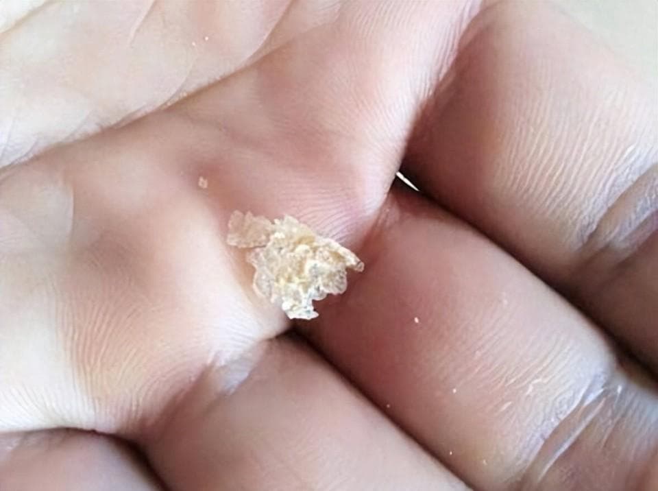 皮肤出现瘙痒、红斑、油腻，是脂溢性皮炎惹的祸，治疗记住3点