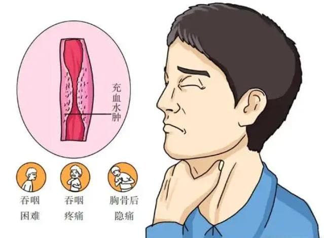 食管癌：愉快进食的“拦路虎”