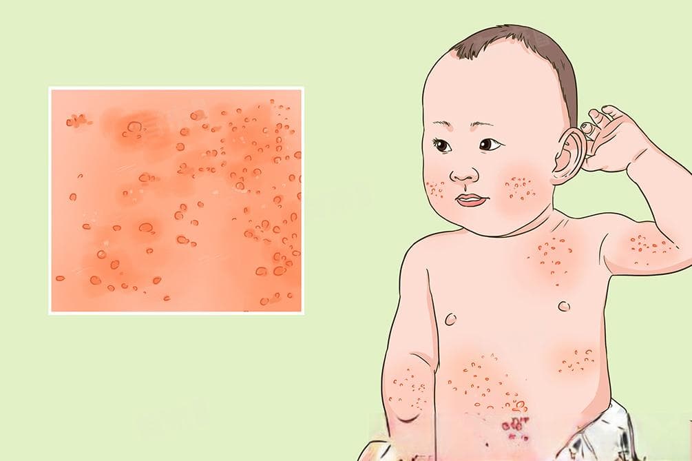小孩湿疹的原因及治疗方法