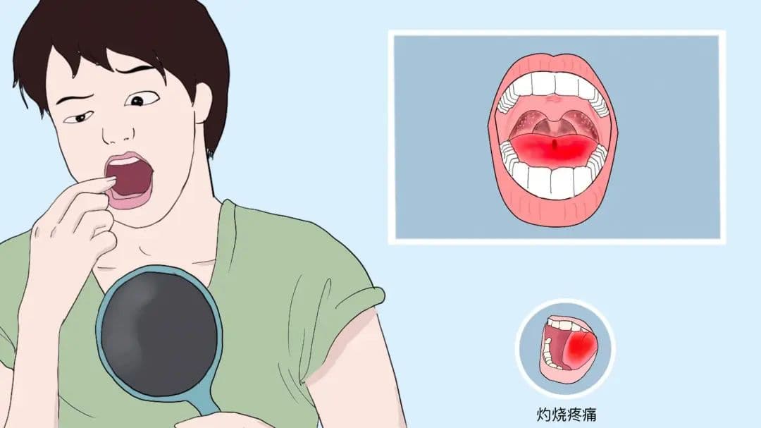 灼口综合征：不明原因嘴巴疼，别慌，不是癌症！