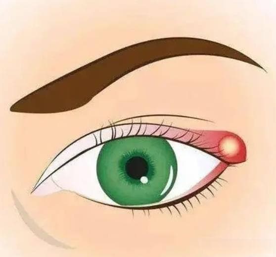 揭秘睑板腺囊肿：原因、治疗与预防