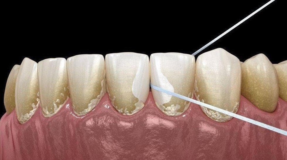 牙结石容易诱发口腔疾病，学会这些方法可减少牙结石！—口腔护理