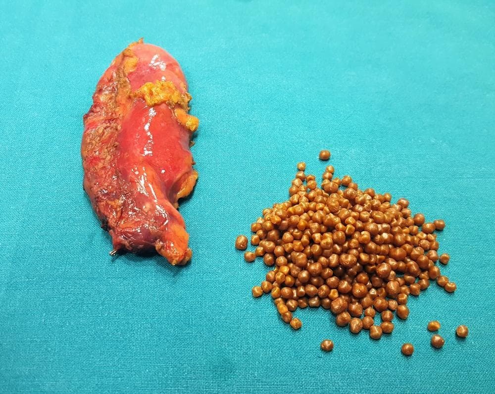 胆结石可自然排出吗？胆结石症状、原因、饮食、手术一次看